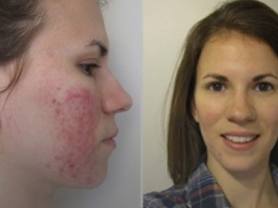 Teenage Acne is common but are there acne treatments that can help my skin clear-up?